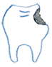 虫歯