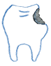 虫歯の治療